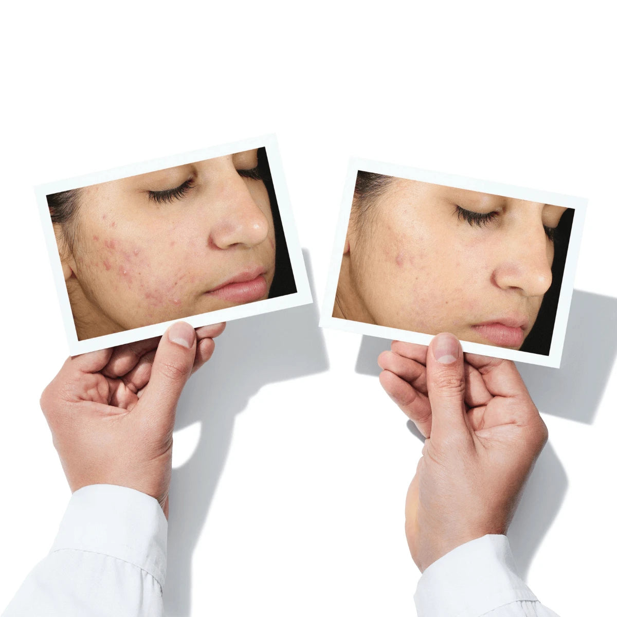 InvisiScar Blemish Scar Treatment, Blemish Control, 15 ml.